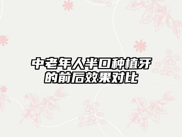 中老年人半口种植牙的前后效果对比