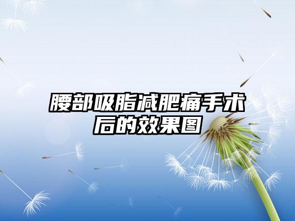 腰部吸脂减肥痛手术后的效果图