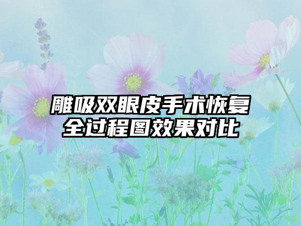 雕吸双眼皮手术恢复全过程图效果对比